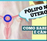 O que são pólipos uterino e quais os sintomas?